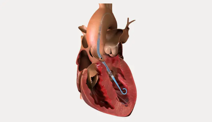 Impella CP with SmartAssist in Heart Illustration teaser image