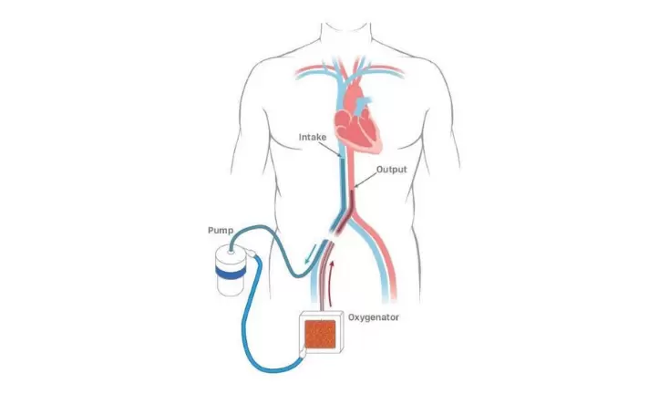 Abiomed Expands Product Portfolio with Acquisition of Cardiopulmonary Support Technology (ECMO) to Improve Outcomes for Patients Press Release Image
