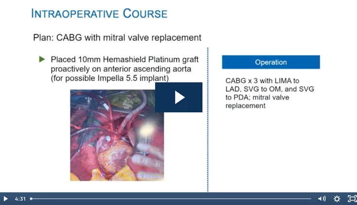 Case Study: PCCS Care Pathway and Use of Impella 5.5® with SmartAssist® Heart Pump

