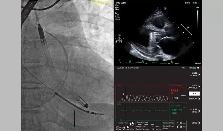 Study Finds 84% Survival Rate in Patients in Cardiogenic Shock and Other Challenging Cardiac Conditions with the New Impella 5.5 with SmartAssist Press Release Image