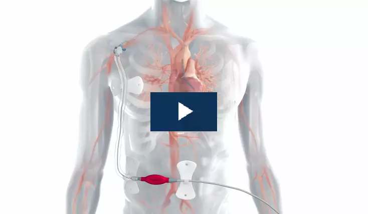 Animation - Impella 5.5 SmartAssist media custom image