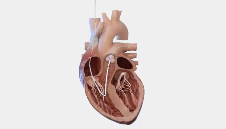 Erfolgreiche Anwendung der preCARDIA-Technologie von Abiomed in früher Machbarkeitsstudie Blog Image