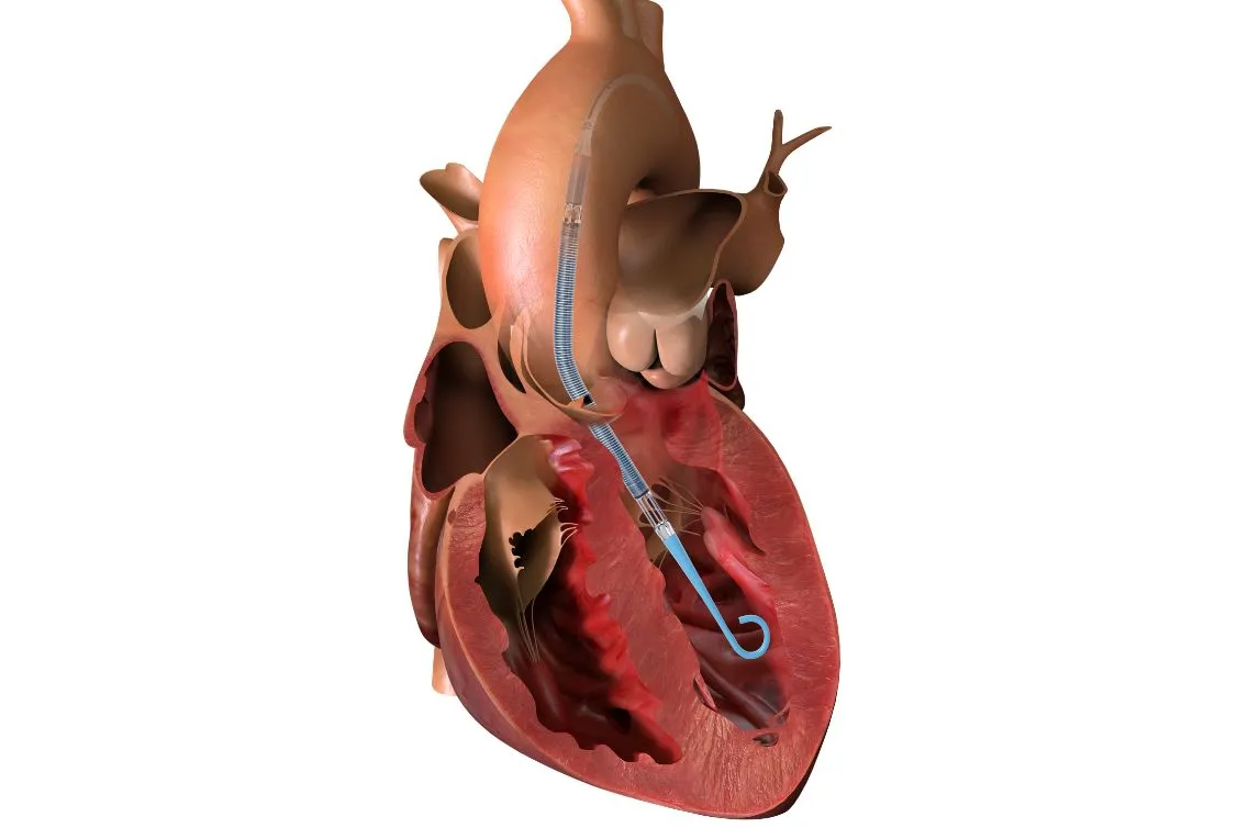 STEMI DTU Press Release Press Release Image