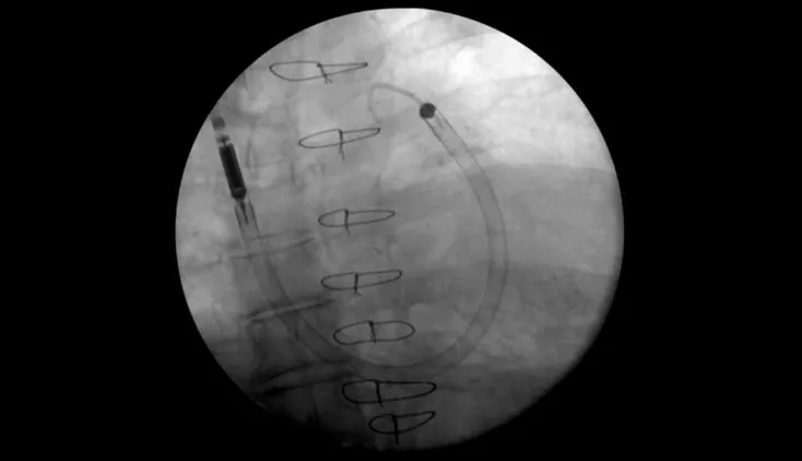 Impella RP Flex® IJ Insertion into Cadaver