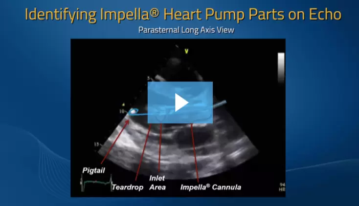 Assessing Impella® Heart Pump Position with Echocardiography
