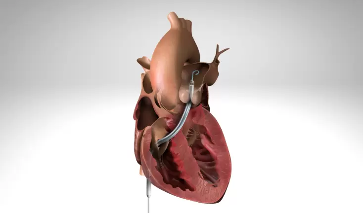 FDA Issues Emergency Use Authorization for Impella RP as Therapy for COVID-19 Patients with Right Heart Failure Press Release Image
