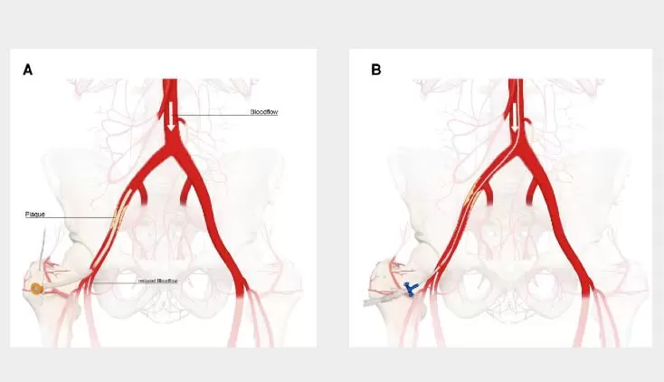 Optimal Bail-Out and Complication Management Strategies in Protected High-Risk Percutaneous Coronary Intervention With the Impella Heart Pump