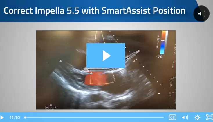 Impella 5.5® with SmartAssist®: Echocardiography for Real-time Positioning
