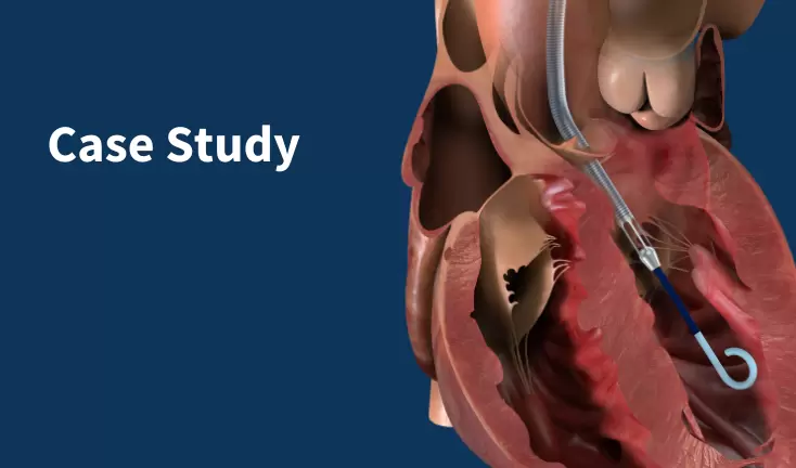 High-Risk PCI with Impella & Shockwave-Assisted Intravascular Lithotripsy