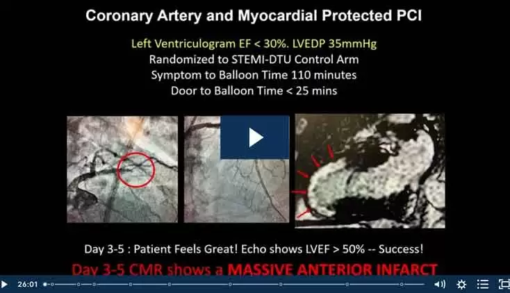 STEMI-DTU™ RCT and the Disruptive Concept of Delayed Reperfusion
