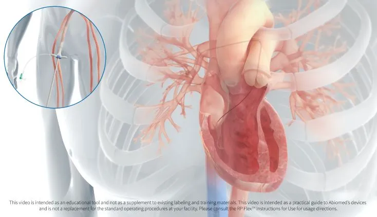 Impella RP Flex™ with SmartAssist® Insertion Animation