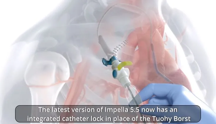 Axillary Implantation and Explantation of Impella 5.5® with SmartAssist® with Juan MacHannaford
