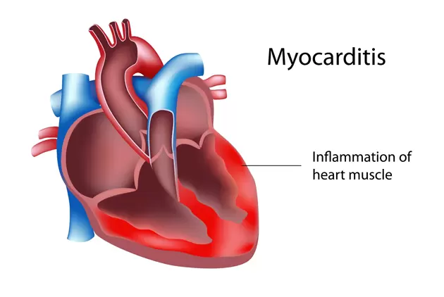 What is Myocarditis? Blog Image