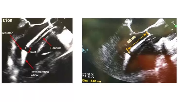 Impella 5.5® TTE and TEE Position Summary teaser image