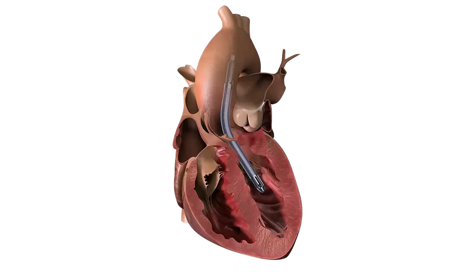 Download Center – Impella 5.5™ with SmartAssist™ Heart Pump teaser image