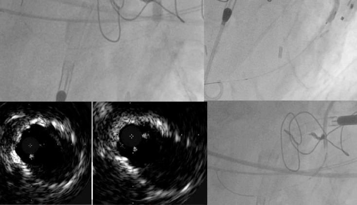 Spezifische klinische Vignetten für geschützte perkutane Koronarinterventionen mit hohem Risiko
