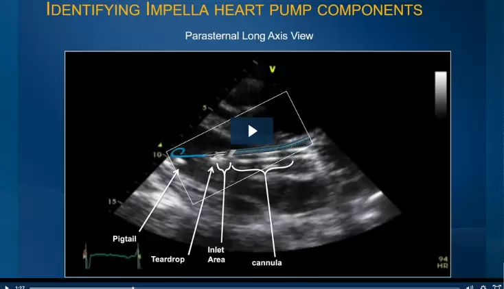 Echo for Impella®: How to Measure and Determine Proper Position
