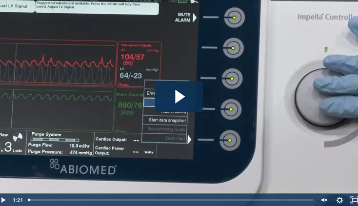 Impella® Skills Video: Adjusting the LV Placement Signal
